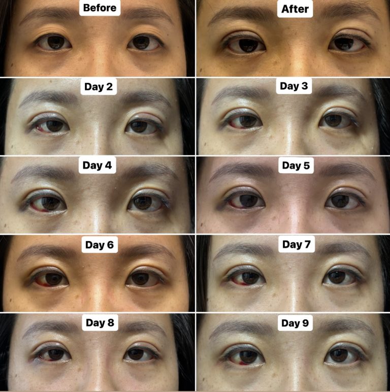 Double Eyelids Non-Invasive Stitching Method + Aftercare